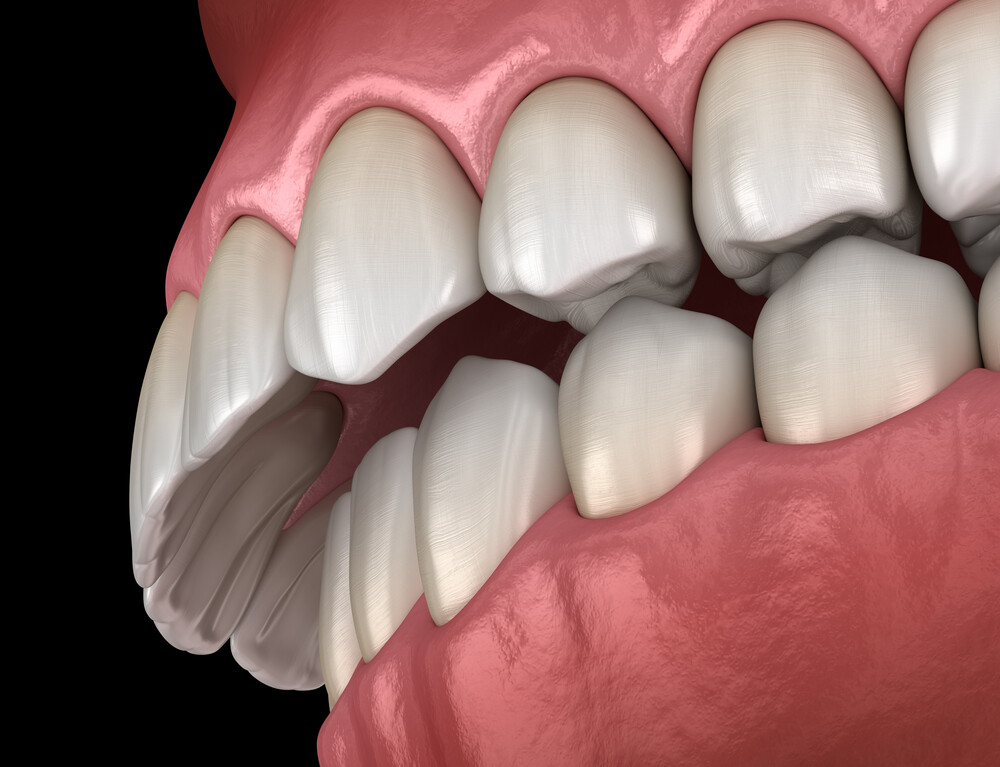 3D illustration, illustration, gum, smile, teeth, photo, bite, care, cavity, chewing, close, closeup, collection, dental, dentist, dentistry, denture, diagnosis, human, hygiene, morphology, macro, malocclusion, mouth, occlusion, oral, orthodontic, orthodontist, tooth, aesthetic, cuspid, 3d illustration, side, Crowded, Malocclusion, Discomfort, Problem, Overbite