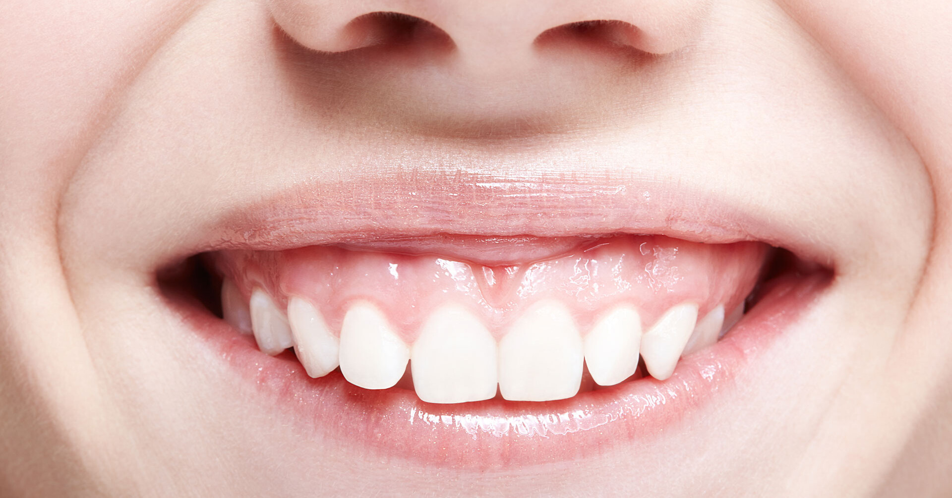 Gummy Smile Zahnfleischüberschuss Korrektur