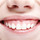 Gummy Smile Korrektur München, Zahnfleischlächeln, Zahnfleischkorrektur, Zahnfleischüberschusskorrektur