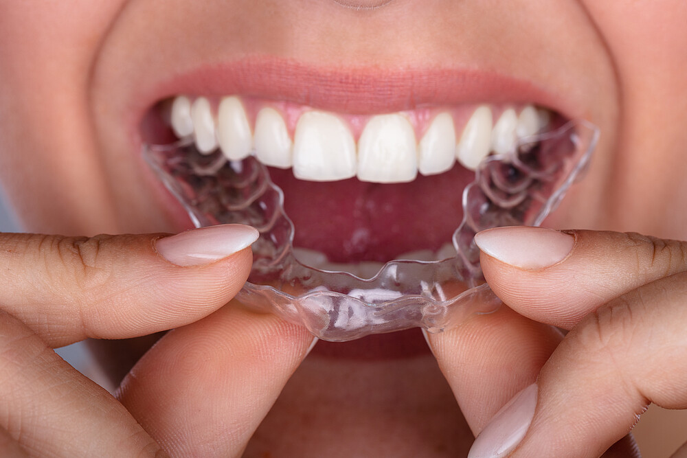 bruxism, aligners, plastic, teeth, clear, woman, putting, transparent, aligner, guard, dentist, whitening, dental, tooth, night, medical, treatment, orthodontics, crunching, patient