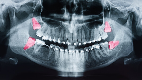 Growing Wisdom Teeth Pain On X-Ray