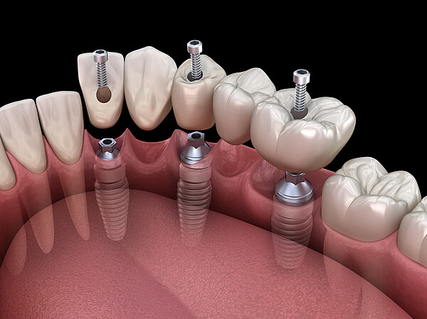 3D illustration, ceramic, artificial, crown, dent, dental, dentist, dentistry, denture, human, illustration, implant, implantat, implantation, implanted, install, installation, jaw, molar, prosthesis, prosthetic, recovery, root, smile, gingiva, surgery, teeth, tooth, transparent, treatment, orthodontic, gum, premolar, titanium, installed, abutment, render, bridge, missing, restoration, console, Animation