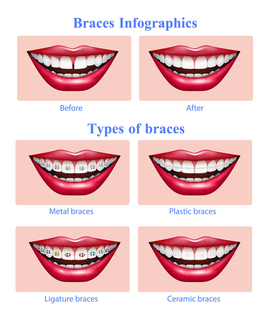 Opened mouth with red glossy lips showing  metal plastic ceramic teeth braces types realistic infographic vector illustration 