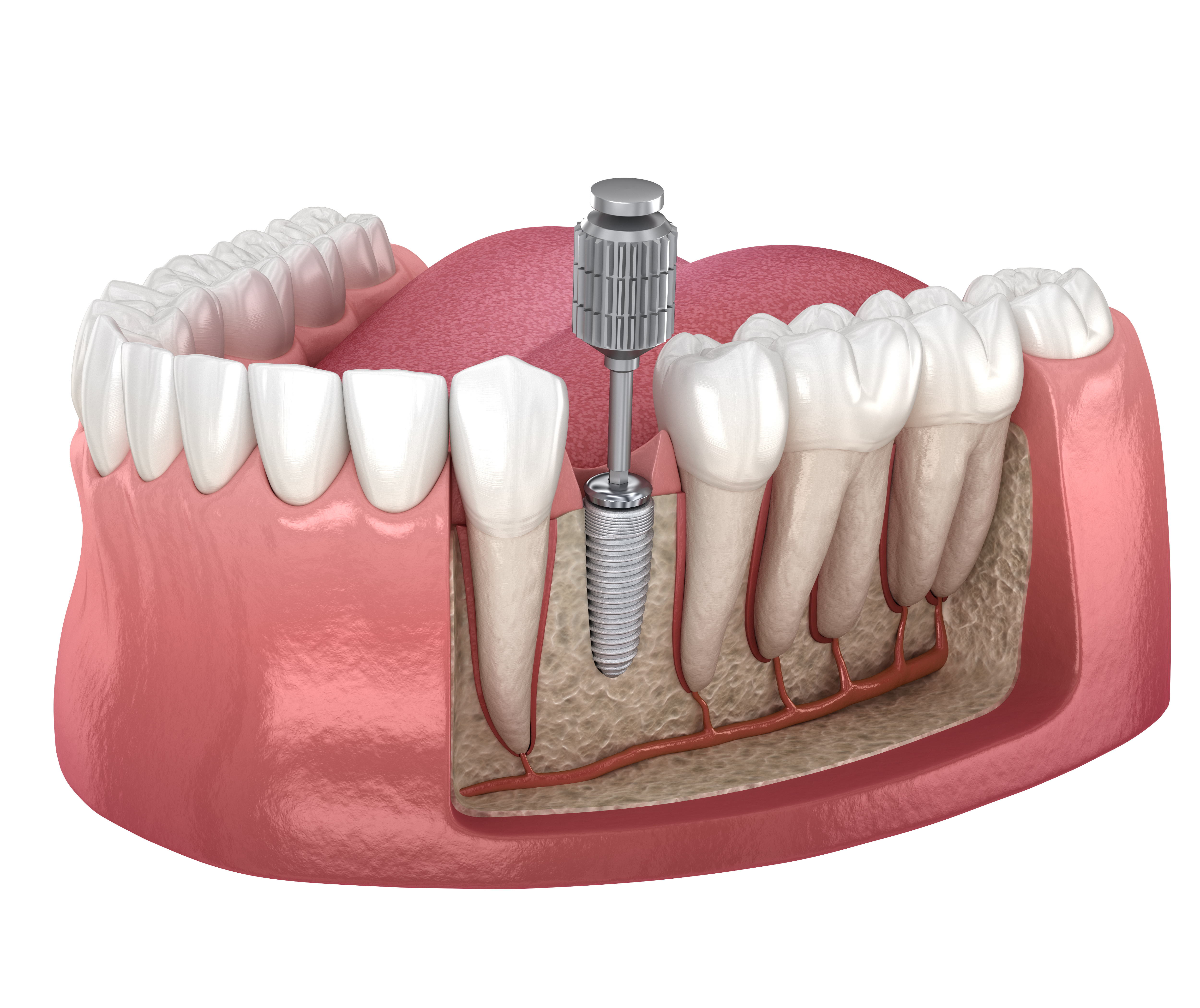 3d illustration, artificial, crown, dent, dental, dentist, dentistry, denture, enamel, example, screwdriver, temporary, illustration, implant, implantat, implantation, implanted, injection, install, installation, jaw, cover, screw, molar, prosthesis, prosthetic, recovery, root, surgery, teeth, titanium, tooth, transparent, treatment, orthodontic, fixation, gum, premolar, installed, abutment, render